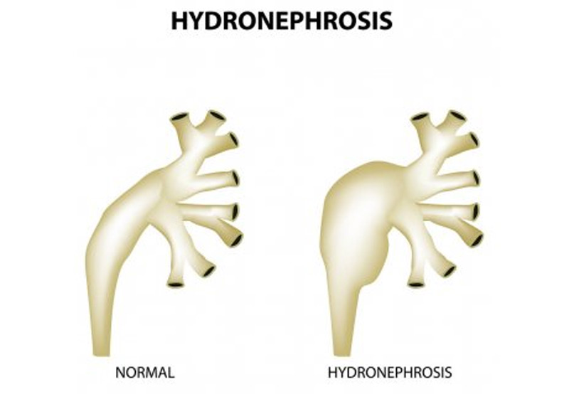 medical-concept-of-hydronephrosis-Dr.-Heidi-Stephany